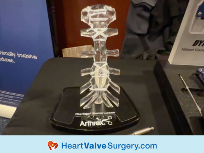 Arthrex Fiber Tape Sternal Closure