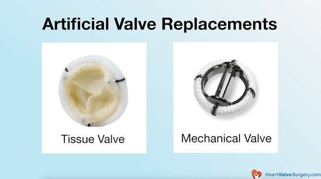 Artificial Tissue & Mechanical Heart Valve Replacement