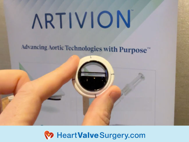 On-X Mechanical Heart Valve Replacement by Artivion