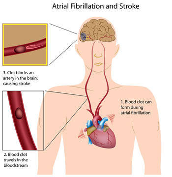 Diagram Showing The Connection Between Atrial Fibrillation & Stroke