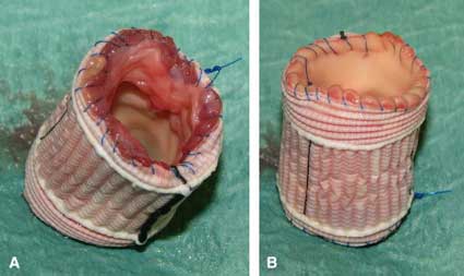 Pulmonary Valve Wrapped During The Ross Procedure