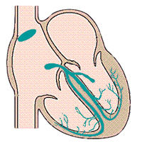 After Heart Surgery AV Block