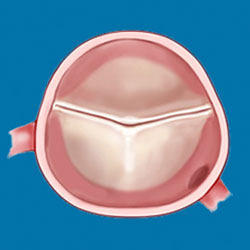 Bicuspid Aortic Valve Conference