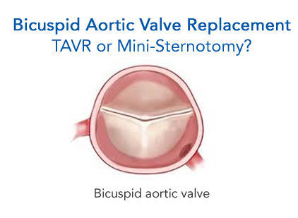 Bicuspid Aortic Valve Tavr Ministernotomy