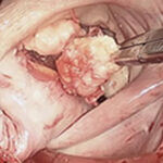 Calcium Mitral Valve Disease