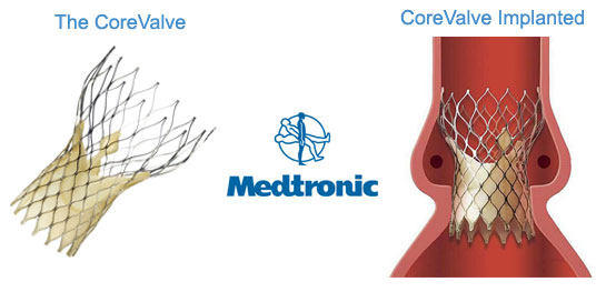 CoreValve Implanted In The Aortic Position