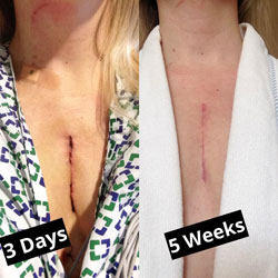 Incision after heart surgery