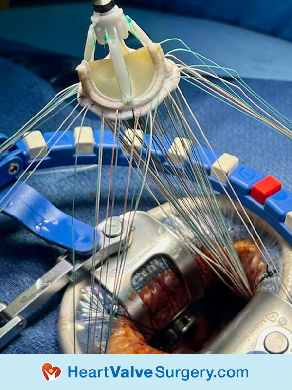 Edwards Lifesciences Aortic Tissue Valve Being Implanted