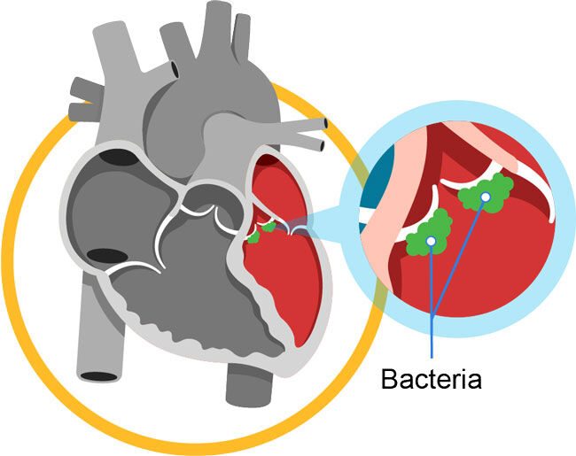 Infections and Heart Surgery