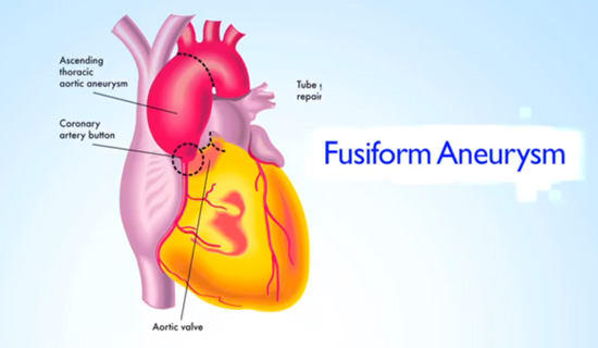 Fusiform Aneurysm Shape