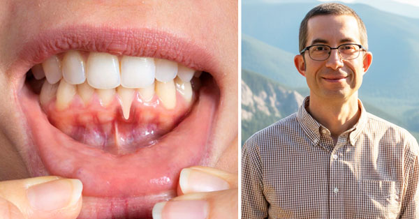 Gum Disease Before Heart Valve Surgery