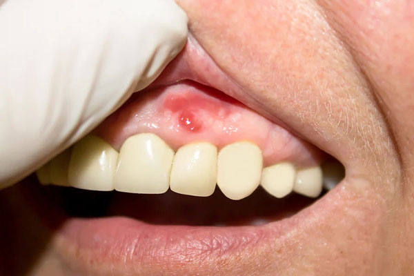 Gum Disease Before Heart Surgery