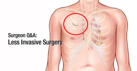 Less Invasive Aortic Valve Surgery