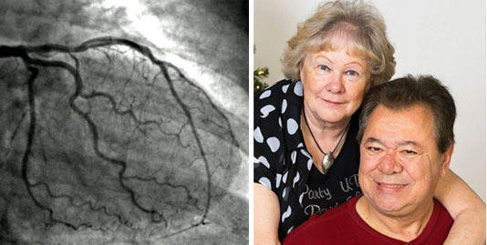 Angiograms Before Heart Surgery