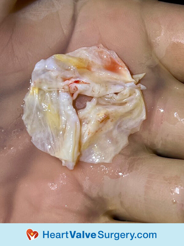 Kim's Aortic Regurgitation Valve