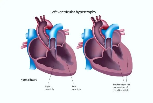 Left Ventricle Enlarged Heart