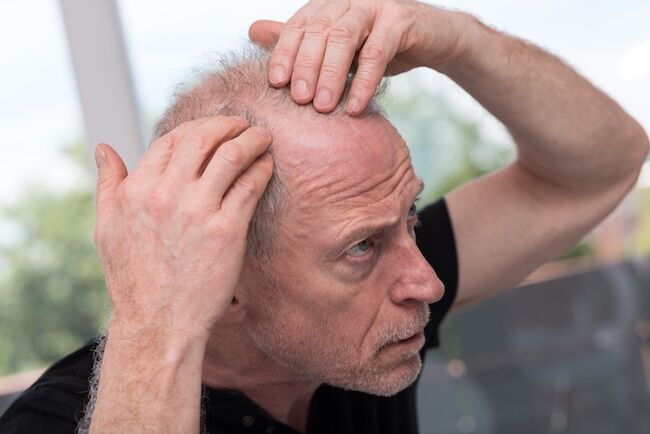Man Losing Hair After Heart Surgery