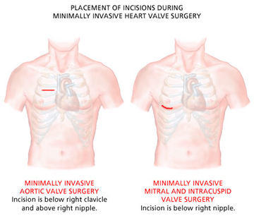 mini-incisions-valve-surgery