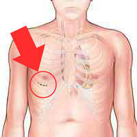 Minimally Invasive Mitral Incision