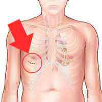 Minimally invasive mitral valve surgery incision