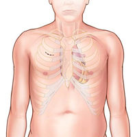 MiniSternotomy-Aortic-Valve