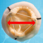 Patient Prosthesis Mismatch (PPM)
