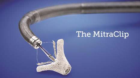 MitraClip by Abbott Laboratories