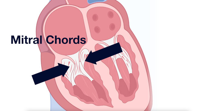 Mitral Chords During Repair