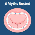 Myths Busted - Heart Valve