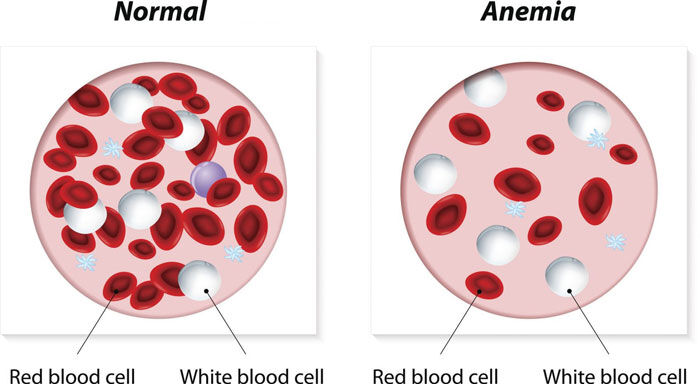 Normal Blood and Anemia Sample - Red and White Cells