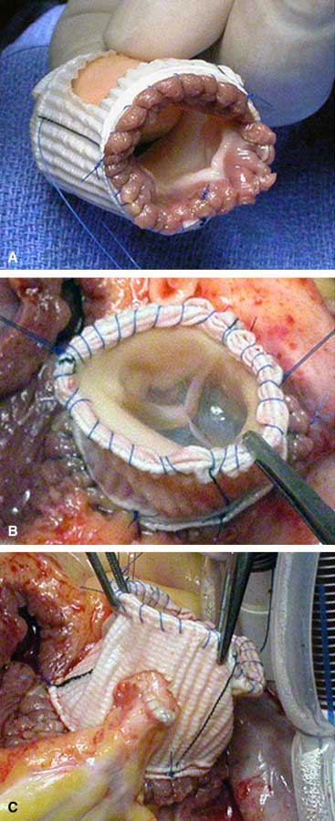 Wrapped Pulmonary Valves In Dacron