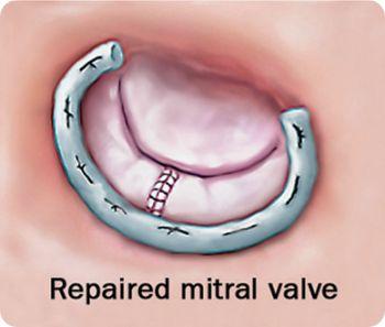 Repaired Mitral Valve with Annuloplasty Ring