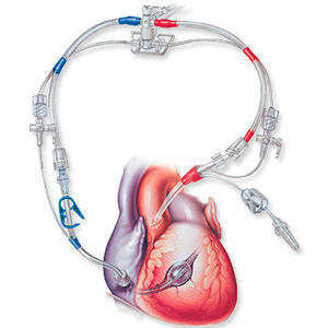 Retrograde Heart Cardioplegia