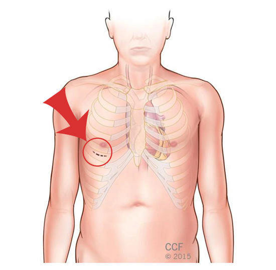 Minimally Invasive Mitral Valve Surgery