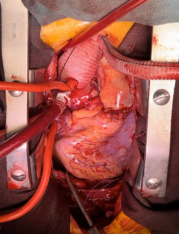 Ross Procedure & Aortic Aneurysm Repair by Dr. Christopher Burke