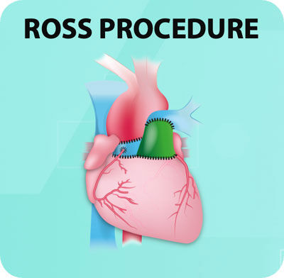 Cirugía del procedimiento de Ross