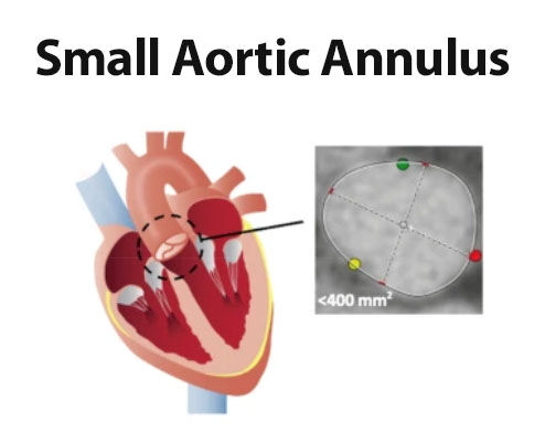Small Aortic Annulus