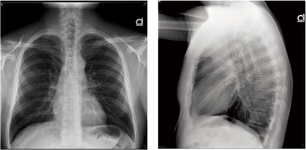 Xray of Sternon Nonunion