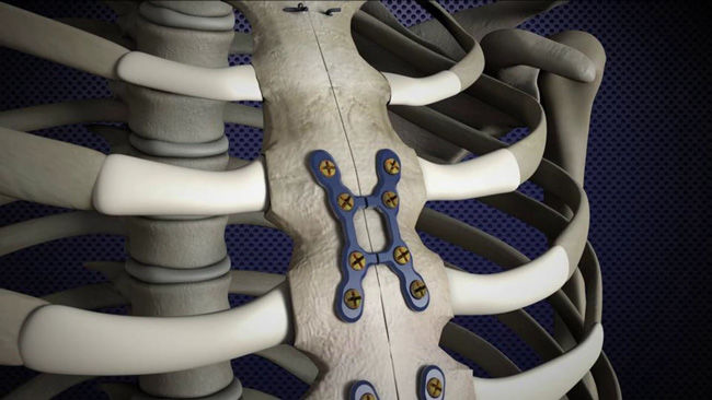 Sternalock rigid sternal fixations with titanium plates