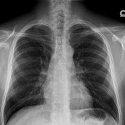 Picture of Sternal Nonunion