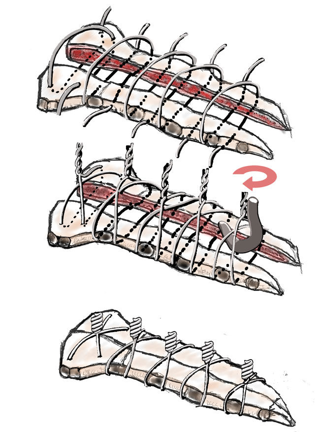 Sternum Wires