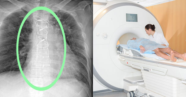 Sternum Wires and MRI Machine