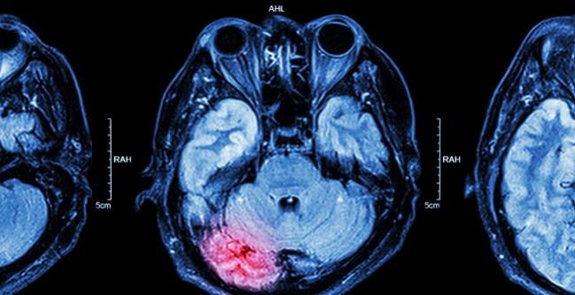Stroke Risk After TAVR (Brain Xray)