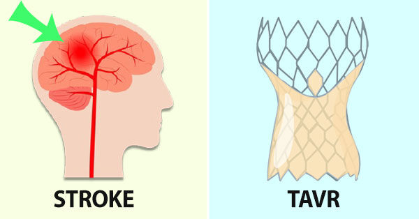 TAVR After Stroke