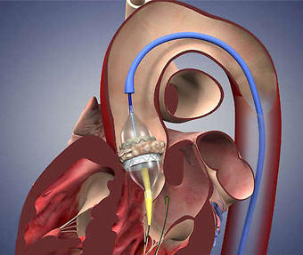 TAVR Sapien by Medtronic