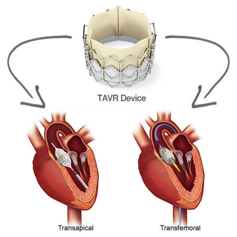 TAVR-Transapical-Transfemoral-Approach