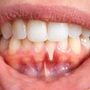 Teeth with Gum Disease