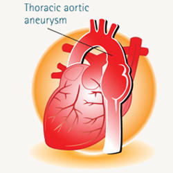 Thoracic Aortic Aneurysm Diagram