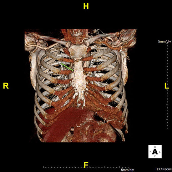 Transaortic TAVR Incision Diagram