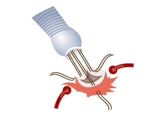 Diagram of An Aortic Root Replacement